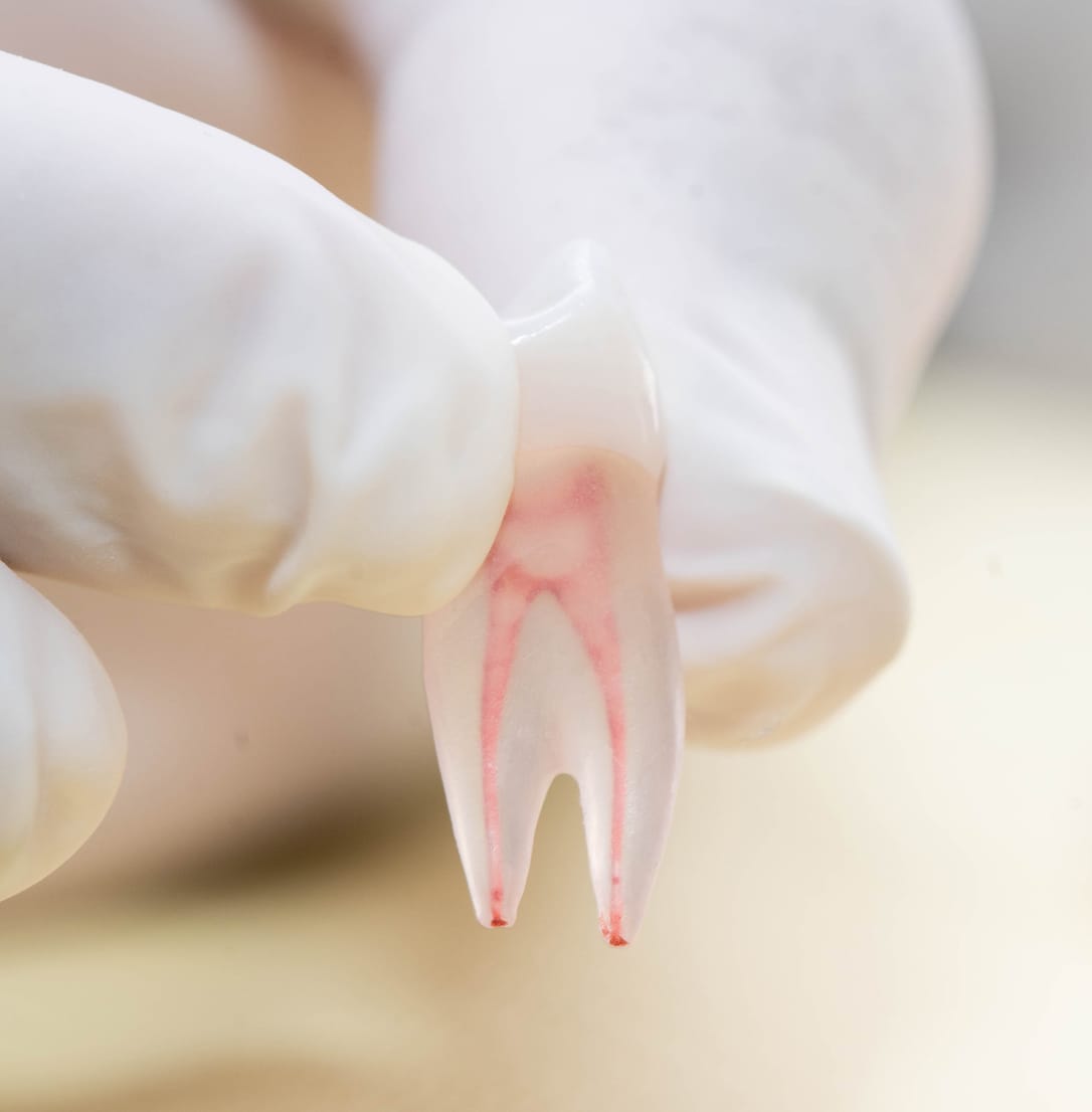  transparent resin tooth model held by gloved hands, showing the red internal root canal system.